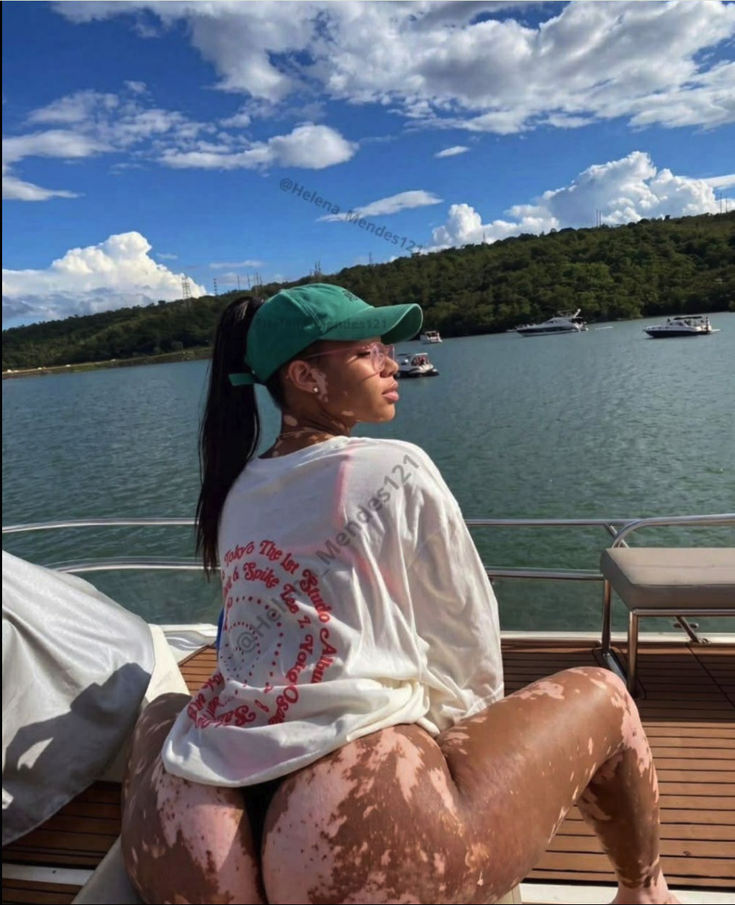 A woman with vitiligo seated on a yacht wearing a green cap and white shirt, with water and boats in the background.