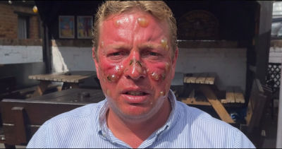 AI-generated image of Thomas Skinner with severe sunburn and blisters