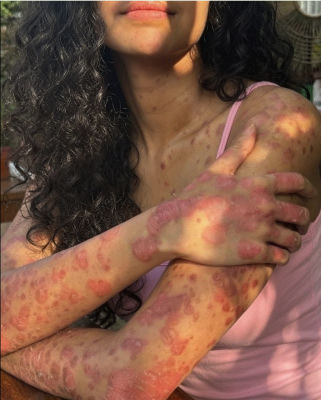 AI-generated image of a person with widespread reddish skin marks across arms and torso